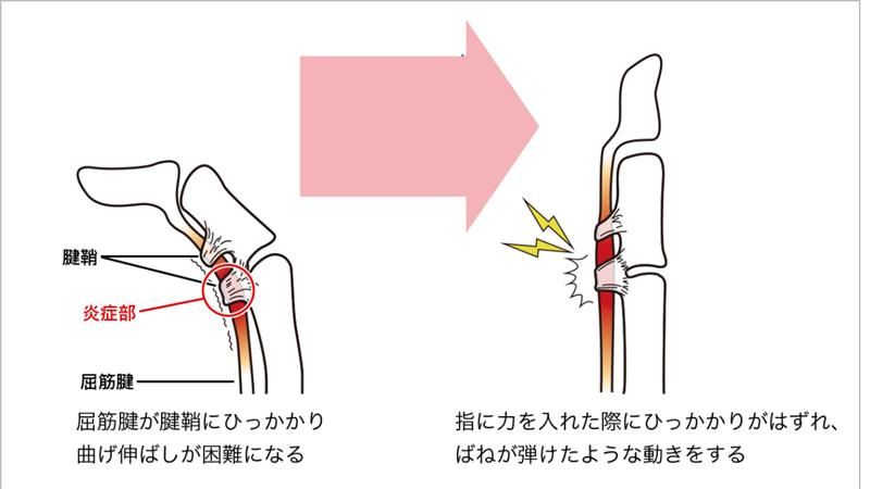 ばね指の原因となる腱鞘と屈筋腱の引っかかりを図で説明したイラスト