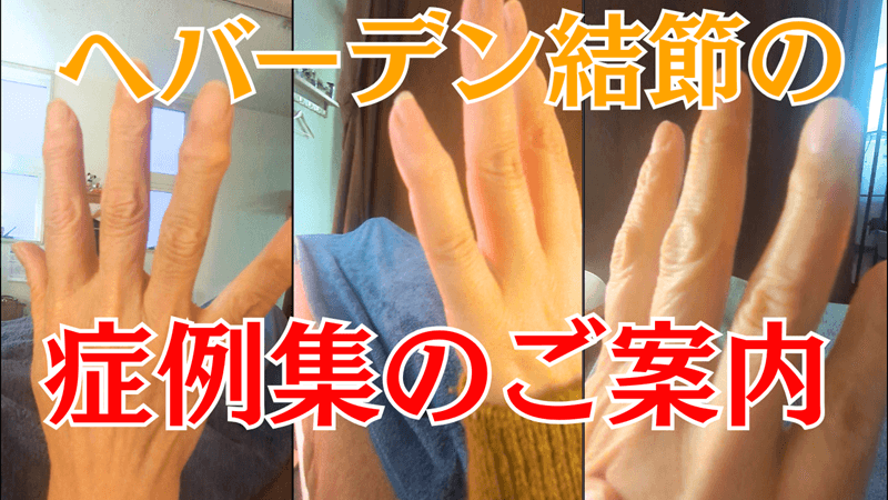 ヘバーデン結節が『治らない』と言われた方の症例