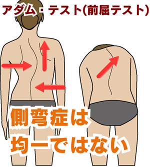 側弯症の検査方法アダム前屈テストのイメージ