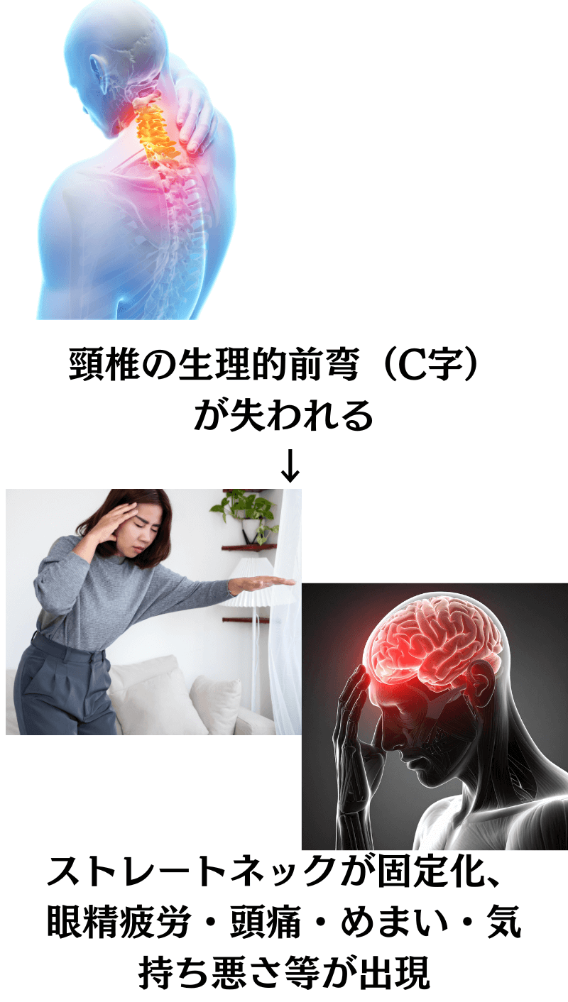 頸椎の生理的前弯（C字）が失われる<br><noscript><img src=